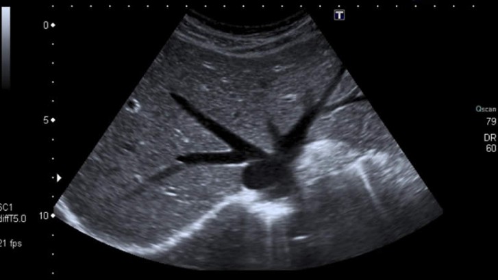 das Bild zeigt, wie sich die Leber im Ultraschall darstellt
