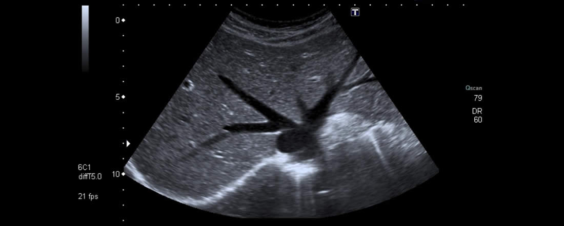 das Bild zeigt, wie sich die Leber im Ultraschall darstellt